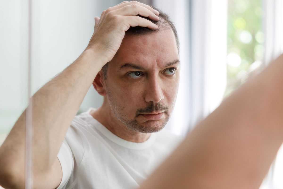 Man looks at bald patches