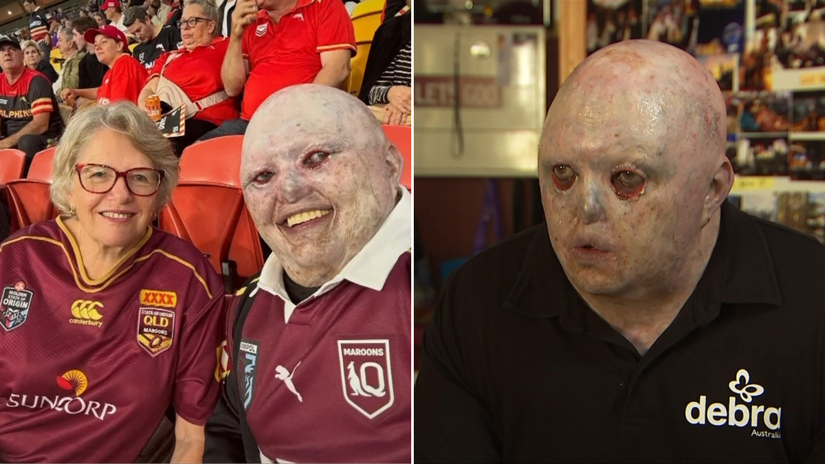 Footy fan with rare skin condition attacked online as Meta AI insults his appearance over innocent photo