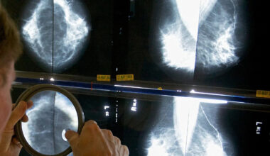 Breast cancer patient spared chemo through trial says it felt ‘like Christmas’