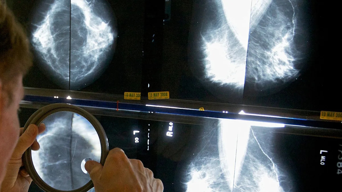 Breast cancer patient spared chemo through trial says it felt ‘like Christmas’