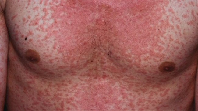 Measles cases are on the rise in Australia.