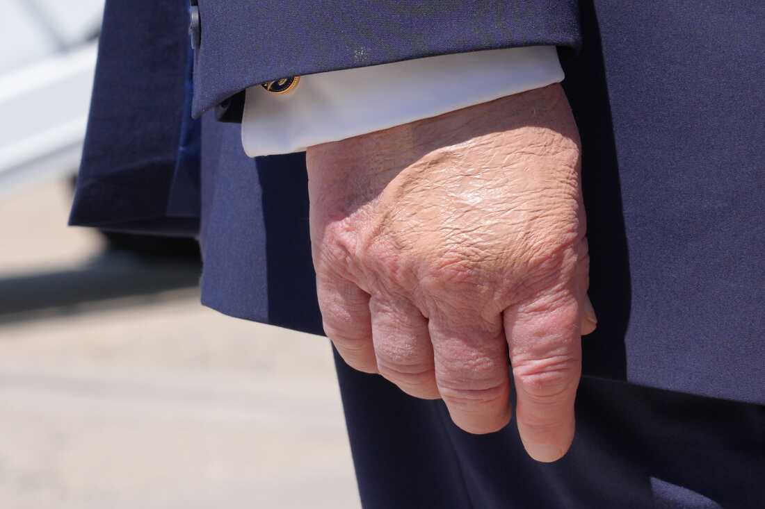 President Donald Trump's right hand is seen as he speaks to the press after returning and stepping off Air Force One, Wednesday, May 20, 2026, at Joint Base Andrews, Md., after speaking at the U.S. Coast Guard Academy commencement.