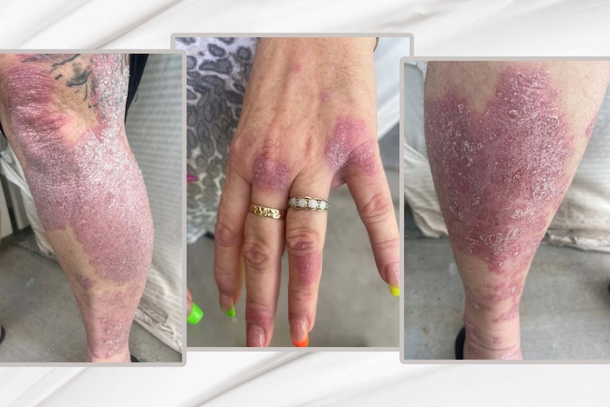 A composite image of three parts of a woman's body, displaying red welts.