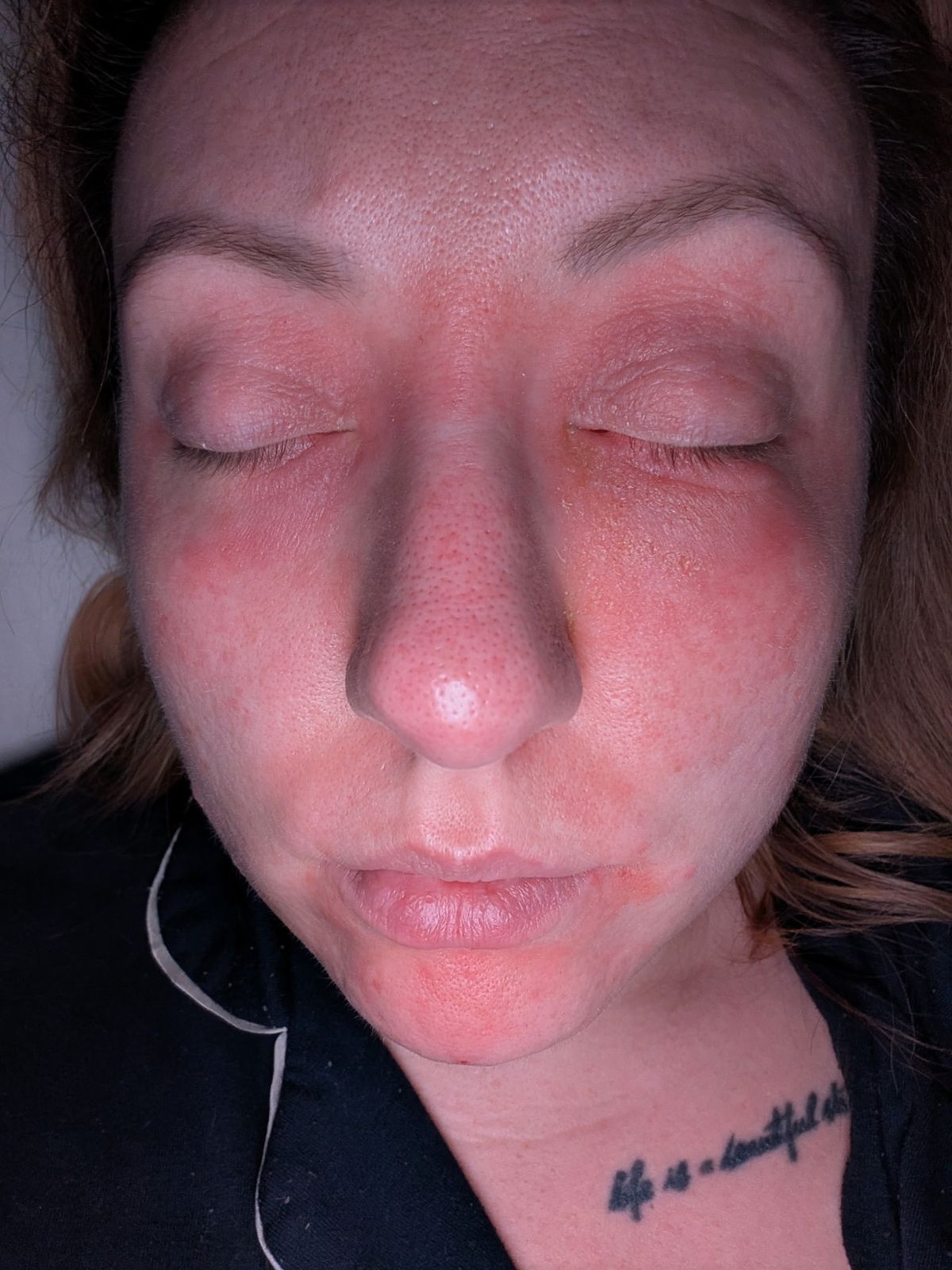 Even her own tears will cause a sore red rash