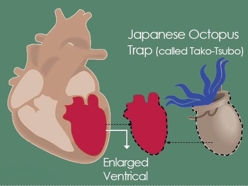 A diagram of a takotsubo heart compared to a heart with the syndrome