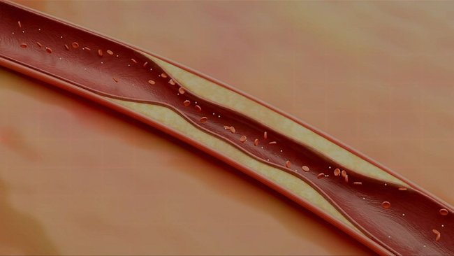 A coronary artery calcium score test looks for calcified plaque in the arteries supplying blood to the heart.