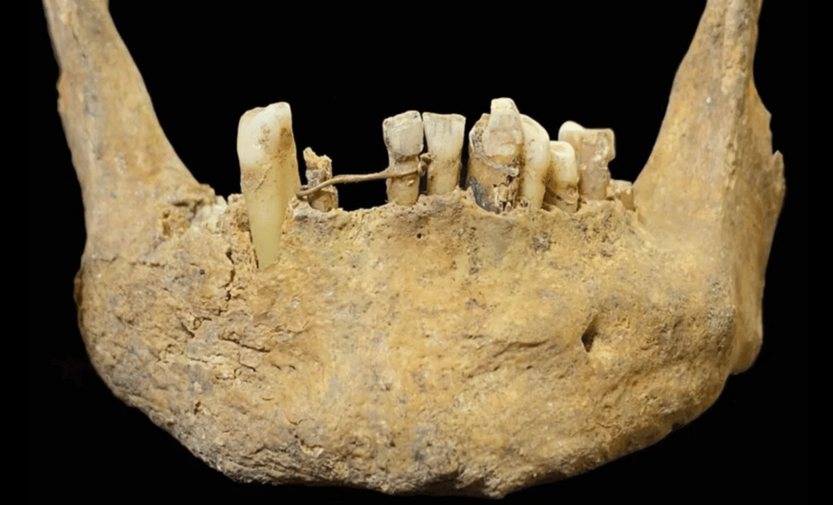 500 Year Old Gold Dental Implant Unearthed In Scotland Reveals Surprisingly Advanced Medieval Dentistry