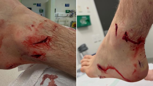 Ed Sloane’s wounds from the attack.