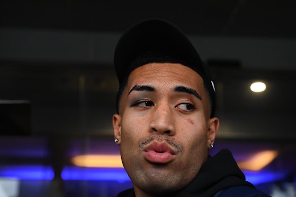 Tolu Koula was sporting a black eye outside Blues HQ on Thursday morning.
