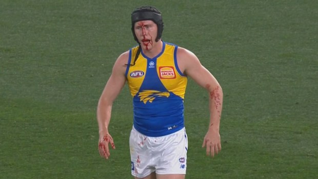 Harry Edwards comes from the game bleeding from the head.