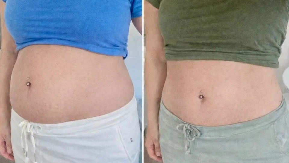 This is two images of Nichola's abdomen edited side by side. To the left, Nichola has a very bloated stomach as a result of an endometriosis flare up. To the right shows Nichola's stomach on an average day which is considerably more flat.