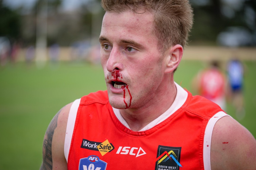 A man with a blood nose runs off the field