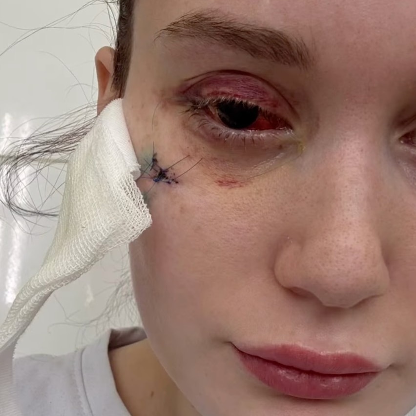 Close up of a woman after she has had surgery on one eye, which appears damaged.