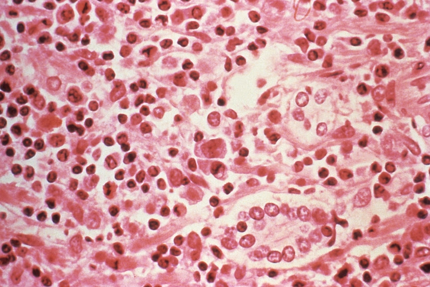 Tissue infected by a virus, as seen through a microscope.