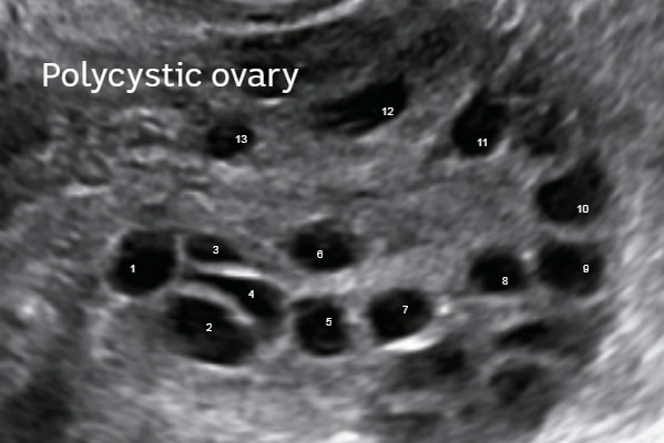 Typical appearance of a polycystic ovary shows a string of black dots on an ultrasound.