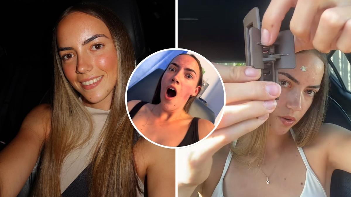 Australian TikTokker Bianca Dilworth’s warning after she had metal removed from her leg when claw clip broke
