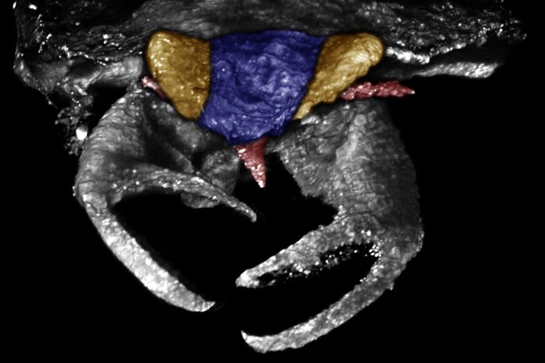CT Scan of Carcinonepa Libererrantes