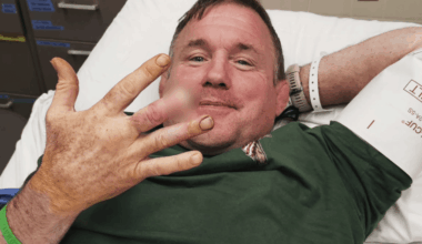 Matt Hughes reveals finger amputation with humorous post
