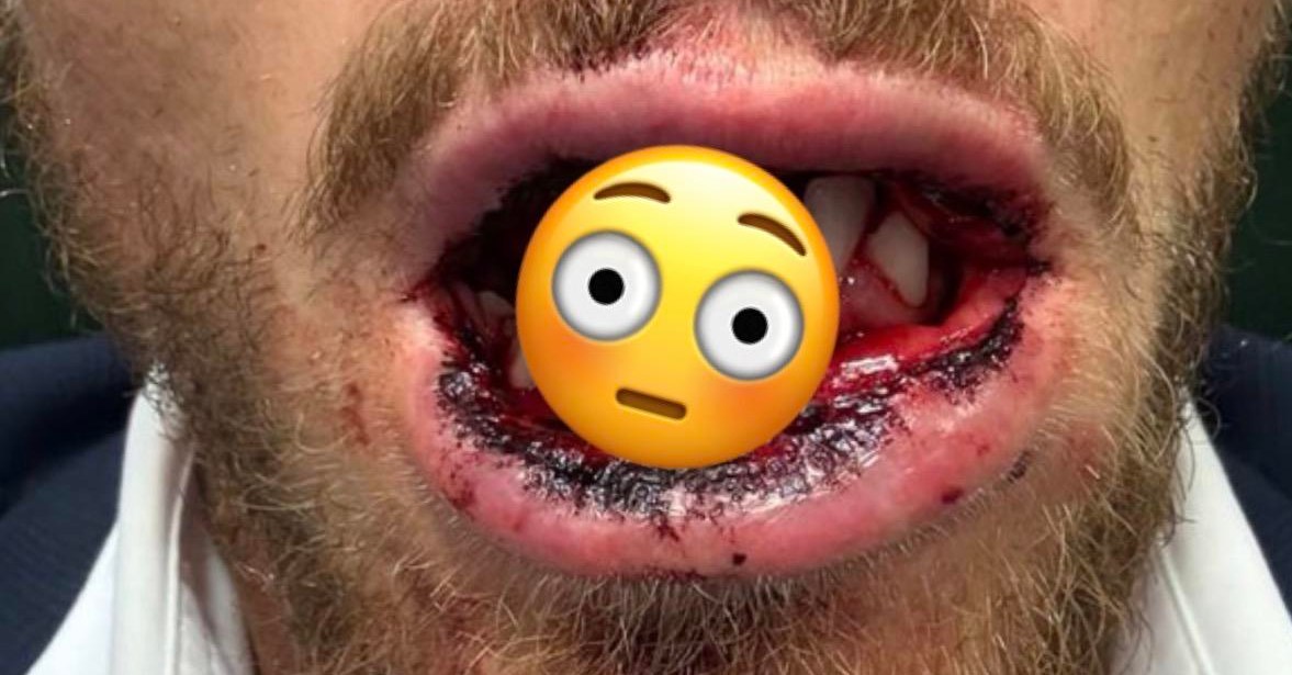 BKFC Headliner Suffers Grisly Broken Jaw Injury