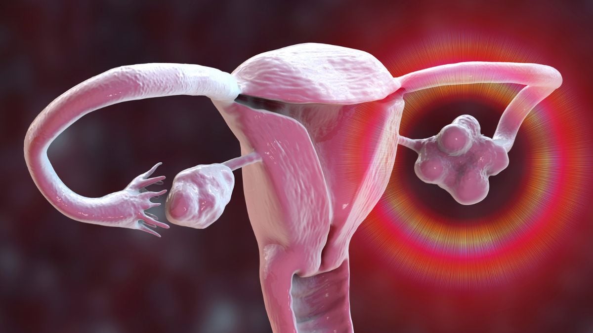 PCOS Is Officially Renamed, After Decades of Misinformation : ScienceAlert