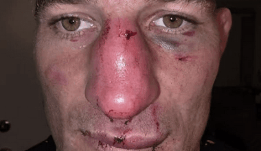 Pic: Sean Strickland shows off gruesome broken nose