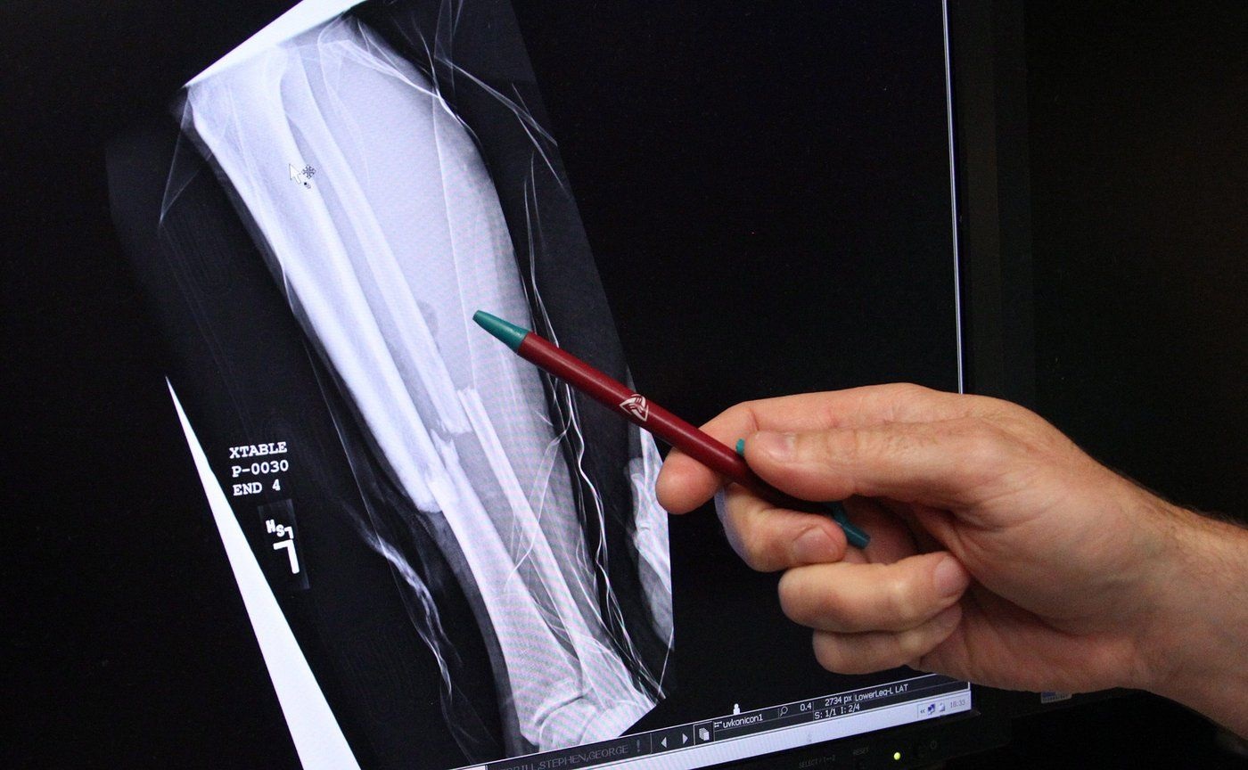 Montreal study sheds light on vitamin K’s role in bone strength