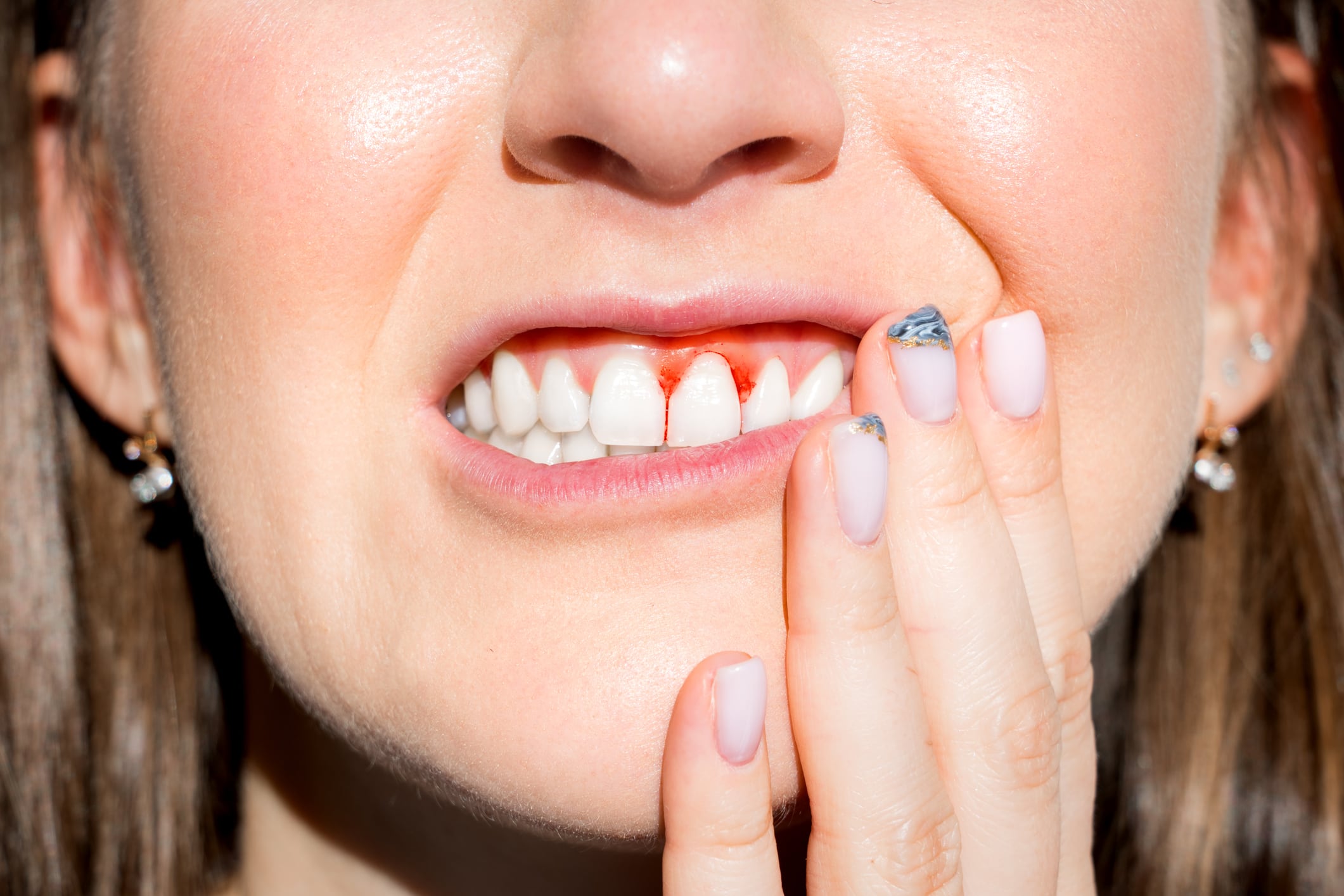Gingivitis is the inflammation of the gums and occurs when microbial plaque  accumulates on the tooth surface due to ineffective tooth brushing.
