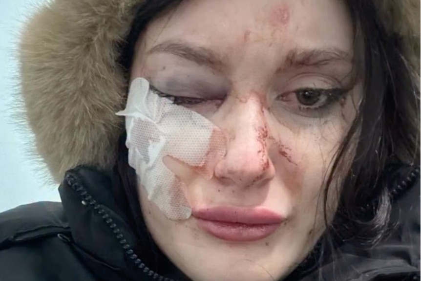 Close up of a woman after she has been assaulted, with bandaging on her cheek and one eye is swollen shut.