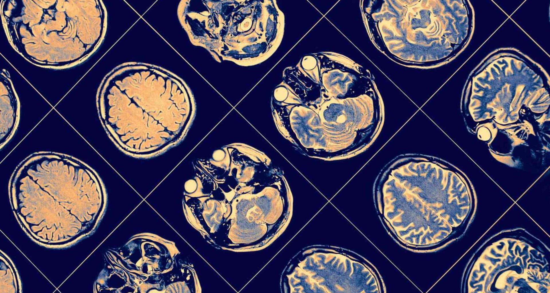 Simple amino acid supplement may help fight Alzheimer’s disease