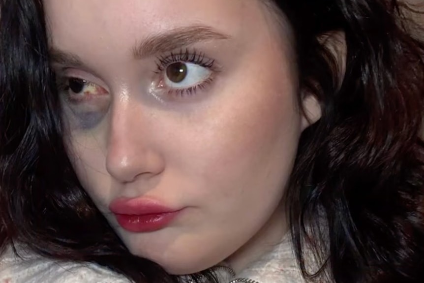 Close up of a woman who has bruisng around one eye.