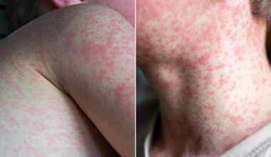Measles cases surge across Australia as vaccination rates decline, outbreaks occur overseas