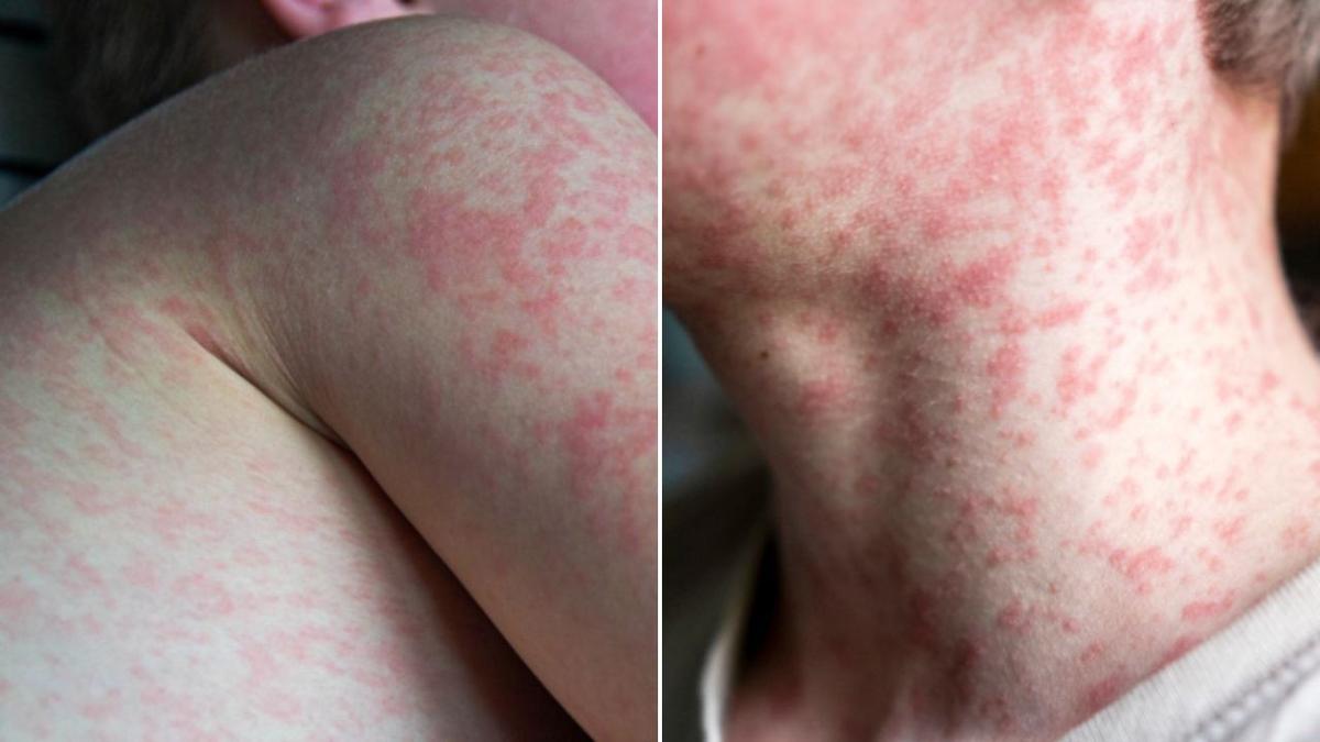 Measles cases surge across Australia as vaccination rates decline, outbreaks occur overseas