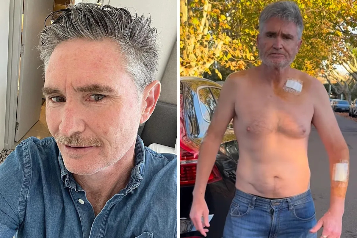 Dave Hughes issues stark skin cancer warning after five cut from his body: '45 stitches'