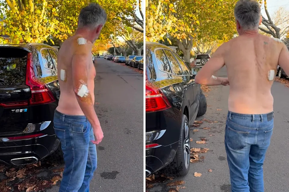 Despite not feeling the best, he was determined to getaThe Australian comedian appeared shirtless in a video where multiple bandages on his chest, back and arms were visible. to his next comedy gig in Cowes, Victoria, to avoid disappointing fans.