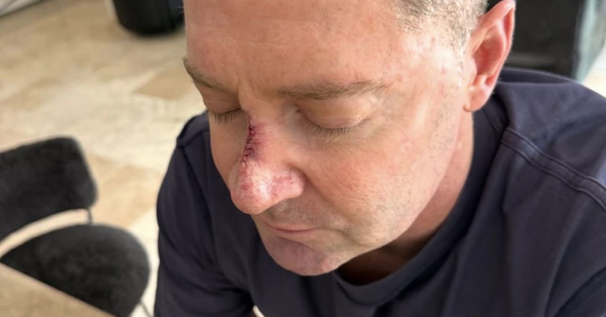 Michael Clarke skin cancer: 'Never a nice feeling': Aussie cricketer Michael Clarke reveals he's had another skin cancer removed from his face