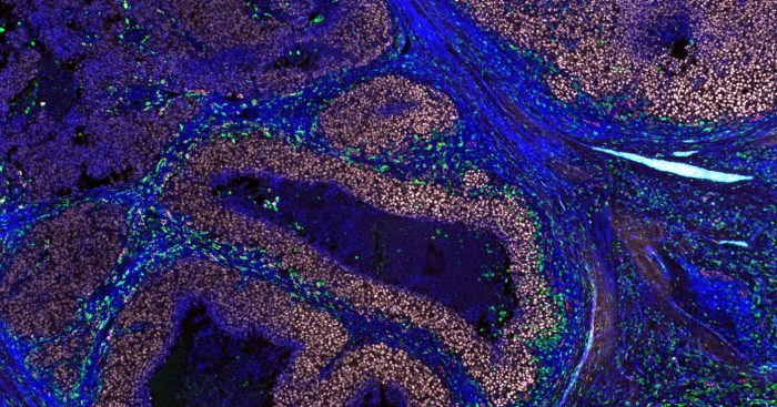 ‘Unexpected and genuinely exciting’: scientists capture immune cells attacking live melanoma