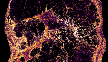 Slowly ticking breast cancer cells offer new clues to late relapse