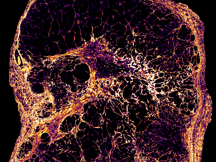Slowly ticking breast cancer cells offer new clues to late relapse