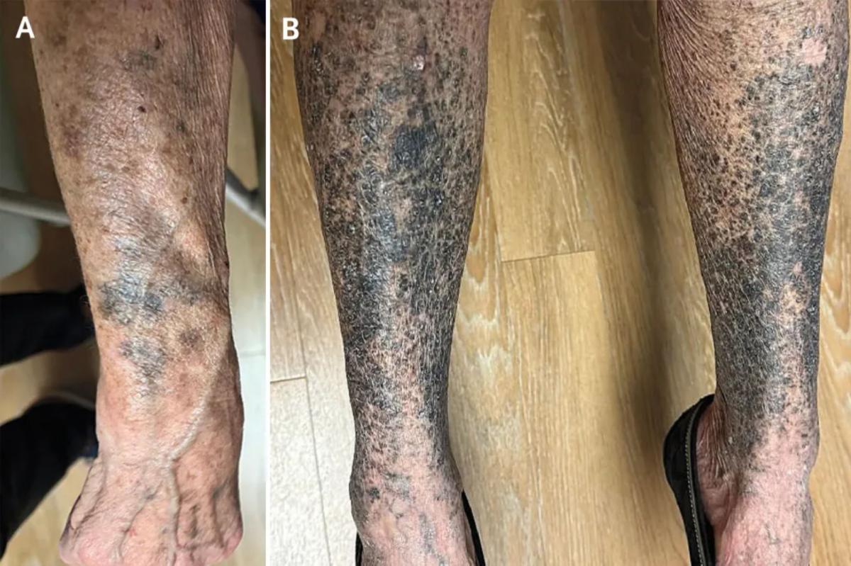 Woman's arms and legs turn blue after taking common drug