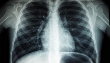 How AI Could Help Cure Pancreatic Cancer