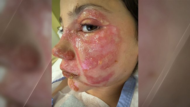 The 10-year-old is warning other children not to copy the dangerous social media craze.