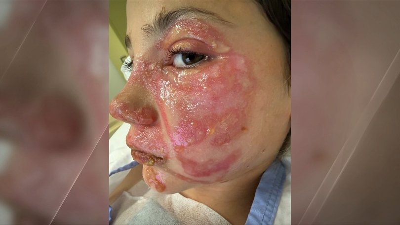 The 10-year-old suffered burns to her face.