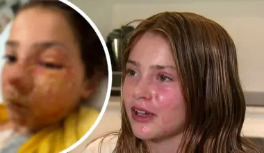 Dad hits back at trolls after daughter Violet Zerbst suffered burns to face after squishy sensory toy exploded