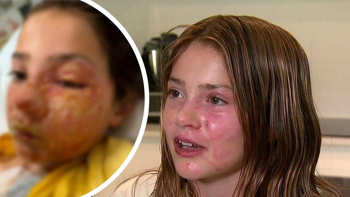 Dad hits back at trolls after daughter Violet Zerbst suffered burns to face after squishy sensory toy exploded