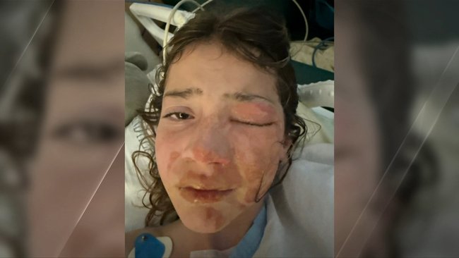 The burns left Violet with significant swelling and injuries across one side of her face.