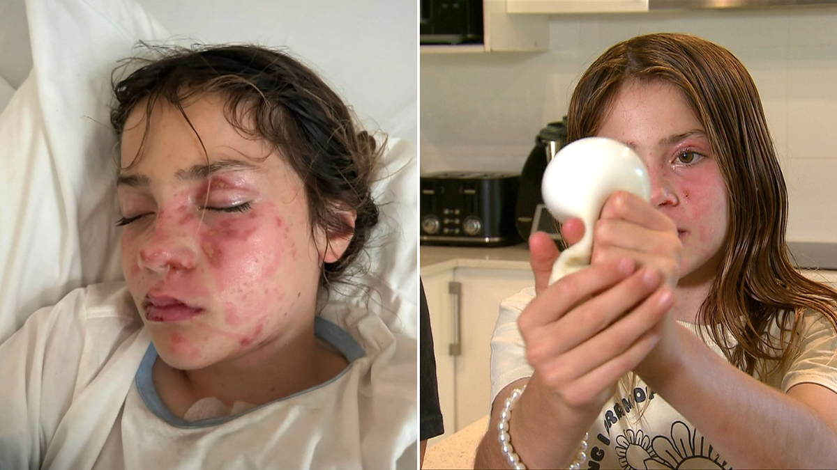 Gold Coast girl suffers severe facial burns after copying dangerous squishy toy social media trend