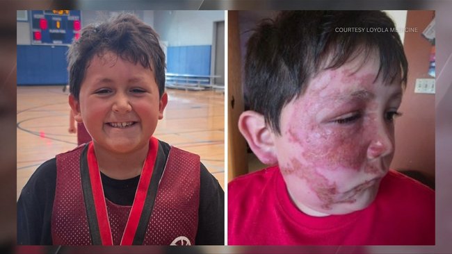A US child suffered severe facial burns in a similar incident involving a heated squishy toy, highlighting concerns about the viral trend.