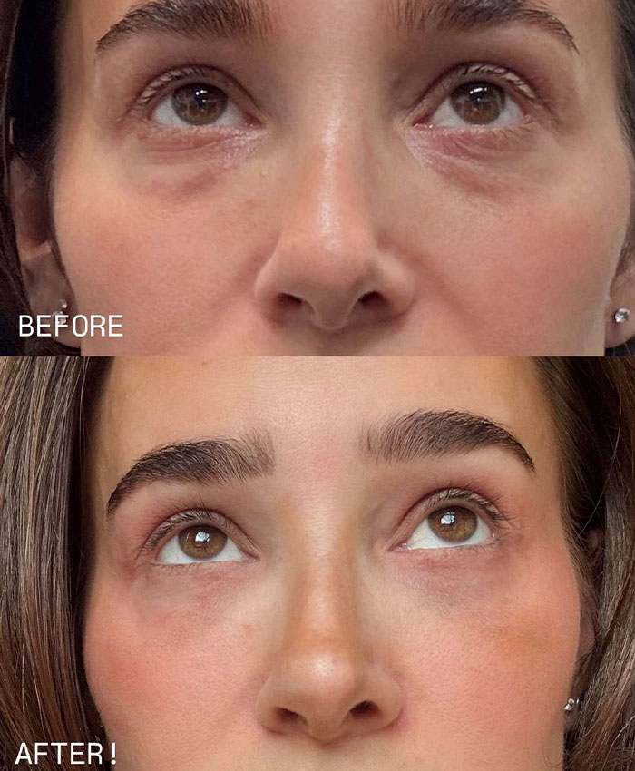 Before and after close-up of under-eye area showing improved skin after procedure Before and after close-up of under-eye area showing improved skin after procedure