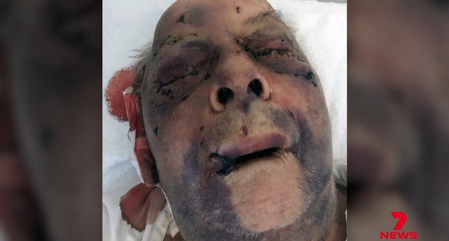 Cain remains in hospital.