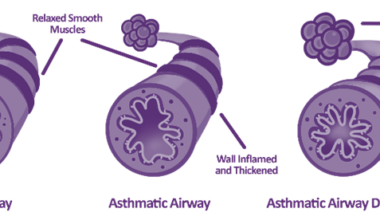Diagram showing normal vs asthmatic airways. An asthmatic airway has inflamed and thickened walls.